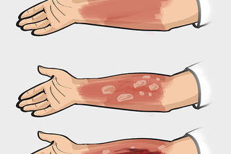 Multiclass Burn wound Classification using Deep learning 