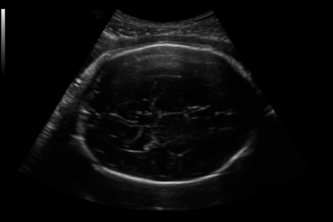 Fetal Head Mesurements