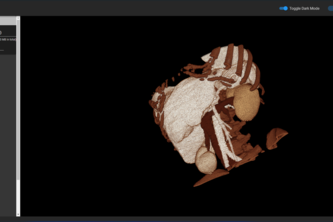 3D reconstruction of 2D Medical Scans