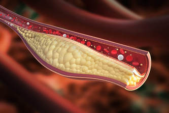 Discover Atherosclerosis