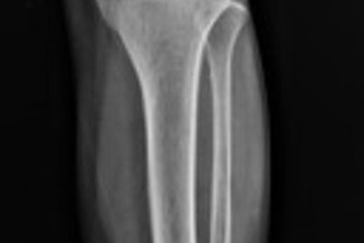 OsteoCNN