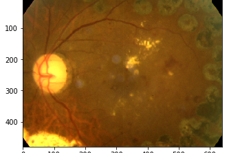 Diabetic Retinopathy Screening Tool