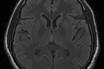 AUTOMATED DETECTION OF TUMORS IN BRAIN MRI