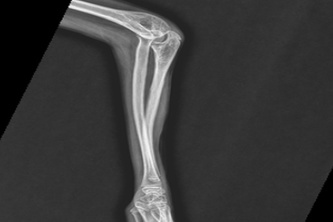 NanoScan: A Novel Tool For Detecting Hairline Fractures 