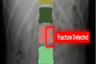 2-D Spinal Segmentation & Fracture Detection
