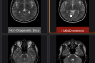 Alzheimer's Detection from MRI Scans