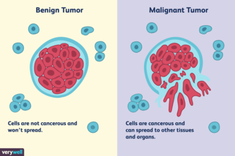 Breast Cancer Classifier