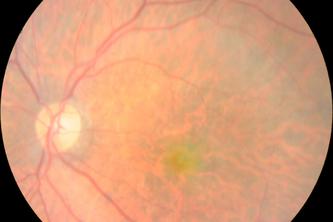 Gemini AI for Early Myopia Screening