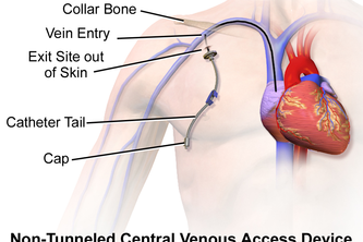 Magnetically Actuated Central Venous Catheter Detector