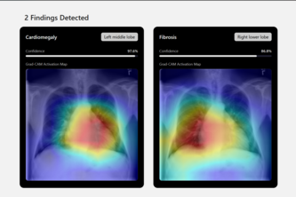Cura: An AI-Powered Application for Chest X-Ray Analysis