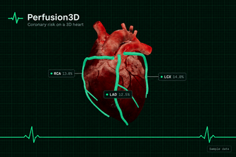 Perfusion3D: Spatial Coronary Ischemia Tool
