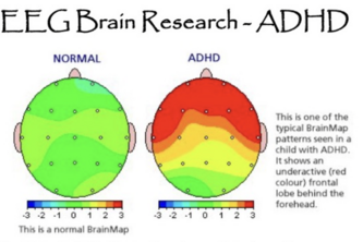 Prosthetic for ADHD
