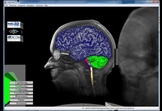 Archival and Web-based Visualization of Volumetric Scans and Clinical Data for TBI using the X3D  International Standard