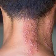 Shingles symptoms  Riyadh's avatar